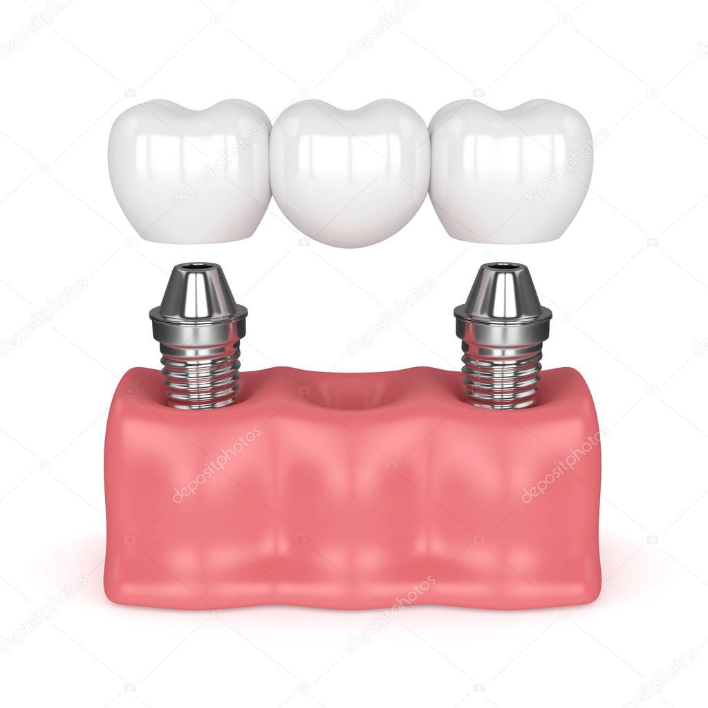 3d render of implants with dental bridge 
