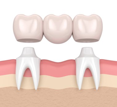 3d render of dental bridge with dental crowns clipart