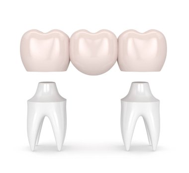 3d render of dental bridge with dental crowns clipart