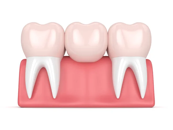 3d renderizado de puente dental con coronas dentales — Foto de Stock