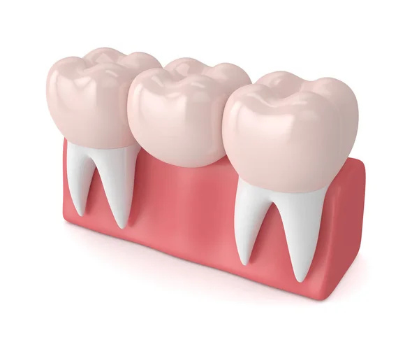 3d renderização de ponte dental com coroas dentárias — Fotografia de Stock