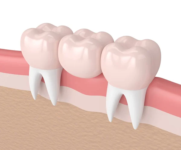 3d renderização de ponte dental com coroas dentárias — Fotografia de Stock