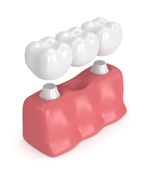 3D візуалізація зубного моста з коронками — стокове фото