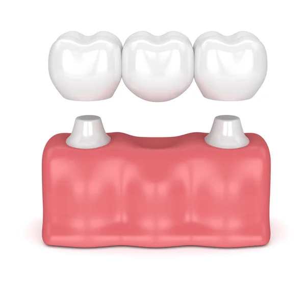 3d render of dental bridge with dental crowns — Stock Photo, Image