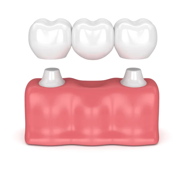 3D рендеринг зубного моста с зубными коронками — стоковое фото