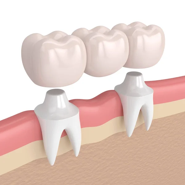 3d render of dental bridge with dental crowns — Stock Photo, Image