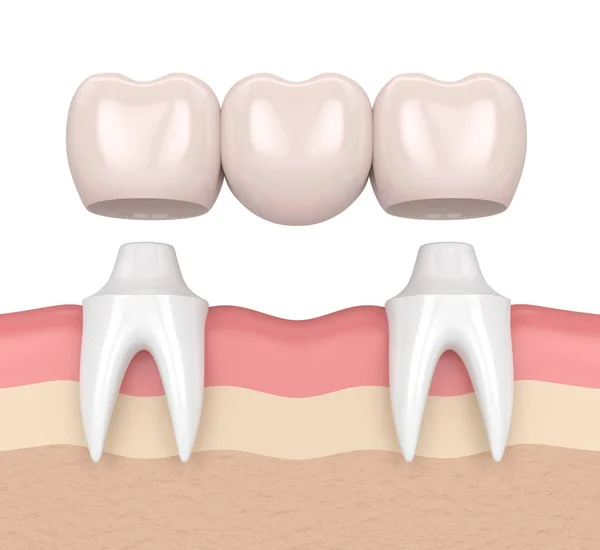 Rendering 3d di ponte dentale con corone dentali — Foto Stock