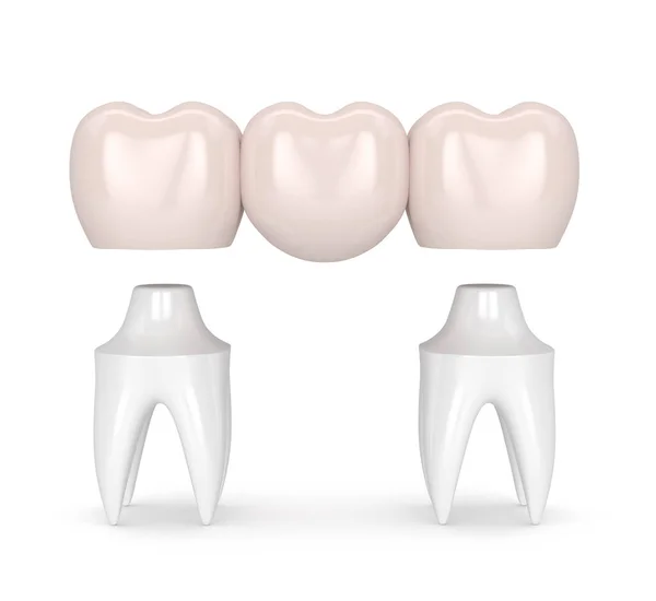 3D činí z zubní můstek s zubních korunek — Stock fotografie