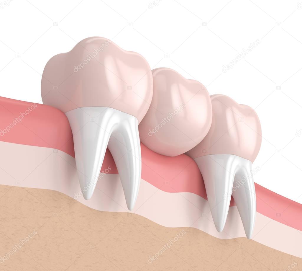 3d render of dental bridge with dental crowns