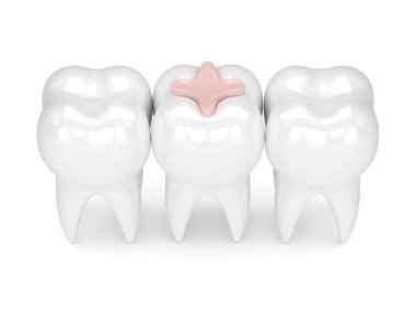 diş diş kakma dolgu ile 3D render