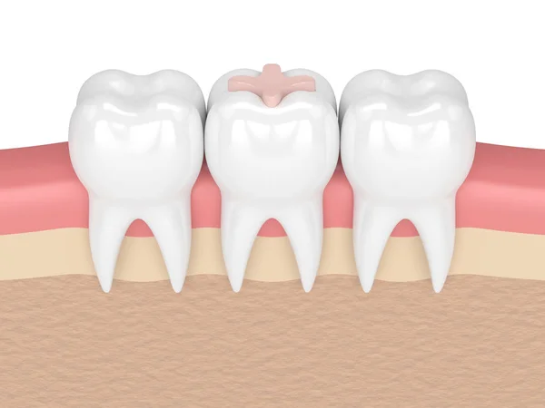 3d render of teeth with dental inlay filling — Stock Photo, Image