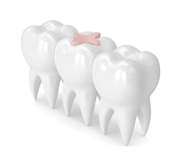 3d renderização de dentes com enchimento dentário inlay — Fotografia de Stock