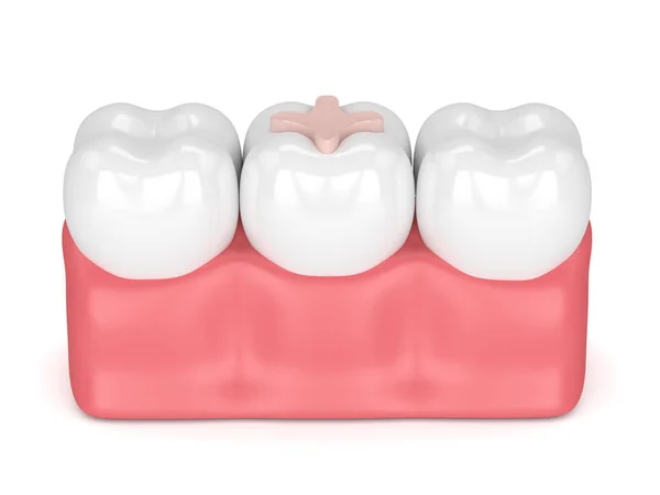 3d визуализация зубов с зубной инкрустацией — стоковое фото
