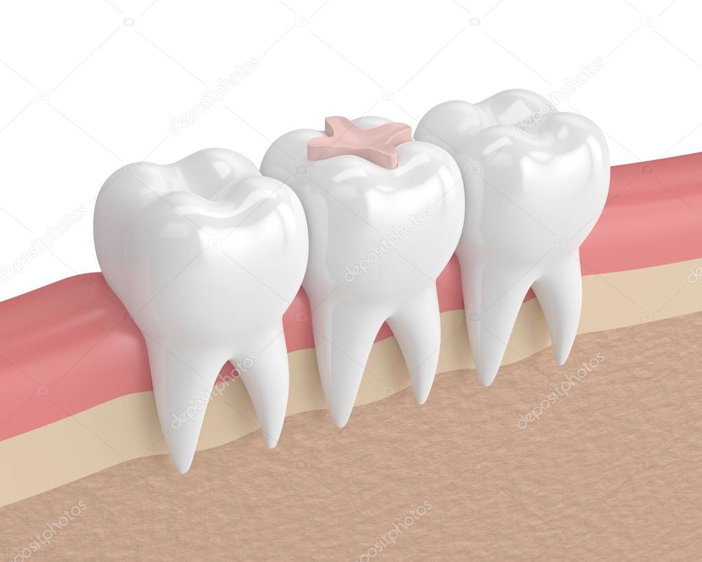 3d render of teeth with dental inlay filling