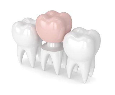 3d render of teeth with dental crown restoration clipart