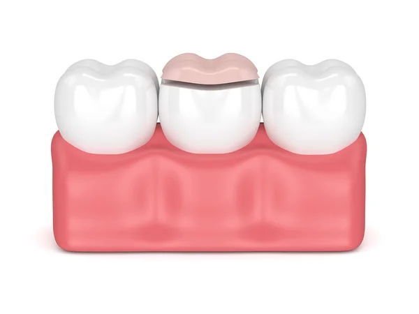 3D-Darstellung der Zähne mit Zahnonlay-Füllung — Stockfoto