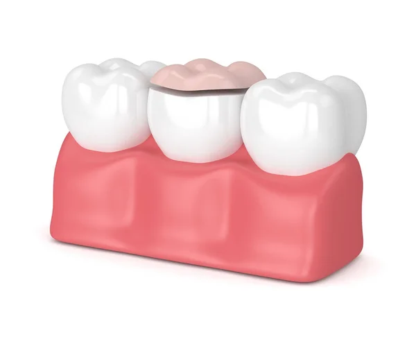 3d render of teeth with dental onlay filling — Stock Photo, Image