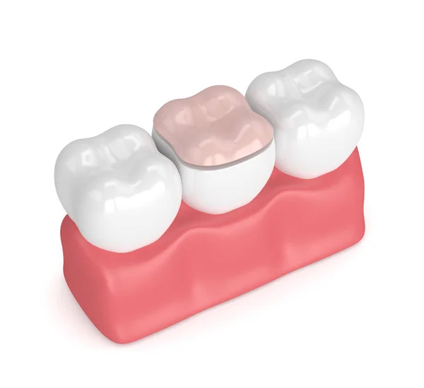 3d renderização de dentes com enchimento onlay dental — Fotografia de Stock