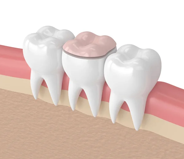 3d render of teeth with dental onlay filling — Stock Photo, Image