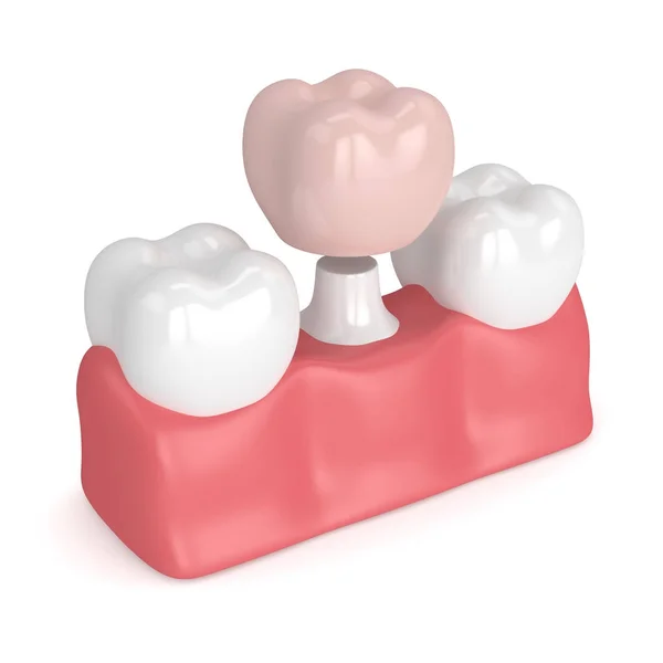 3d render of teeth with dental crown restoration — Stock Photo, Image