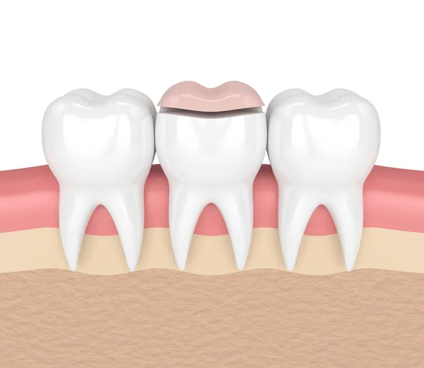 3d renderizado de dientes con relleno de onlay dental —  Fotos de Stock