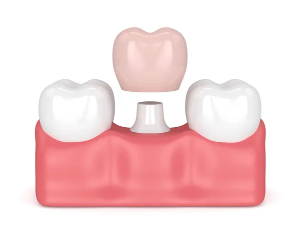 Odwzorowania 3D zębów z Odbudowa korony dentystyczne — Zdjęcie stockowe