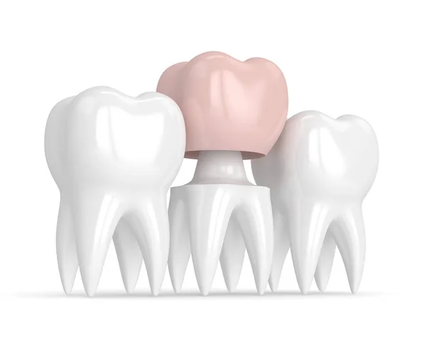 3D візуалізація зубів з реставрацією зубної корони — стокове фото