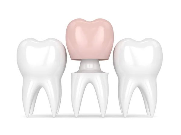 3d renderização de dentes com restauração coroa dental — Fotografia de Stock