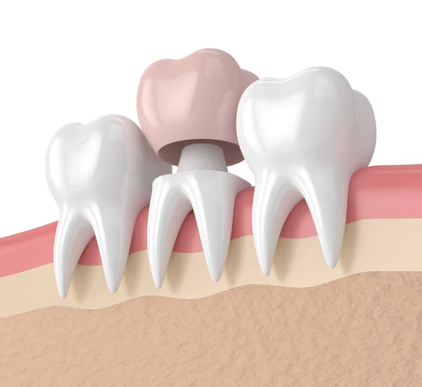 3D renderizado de dientes con restauración de corona dental — Foto de Stock