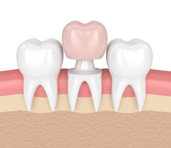 3d render of teeth with dental crown restoration — Stock Photo, Image