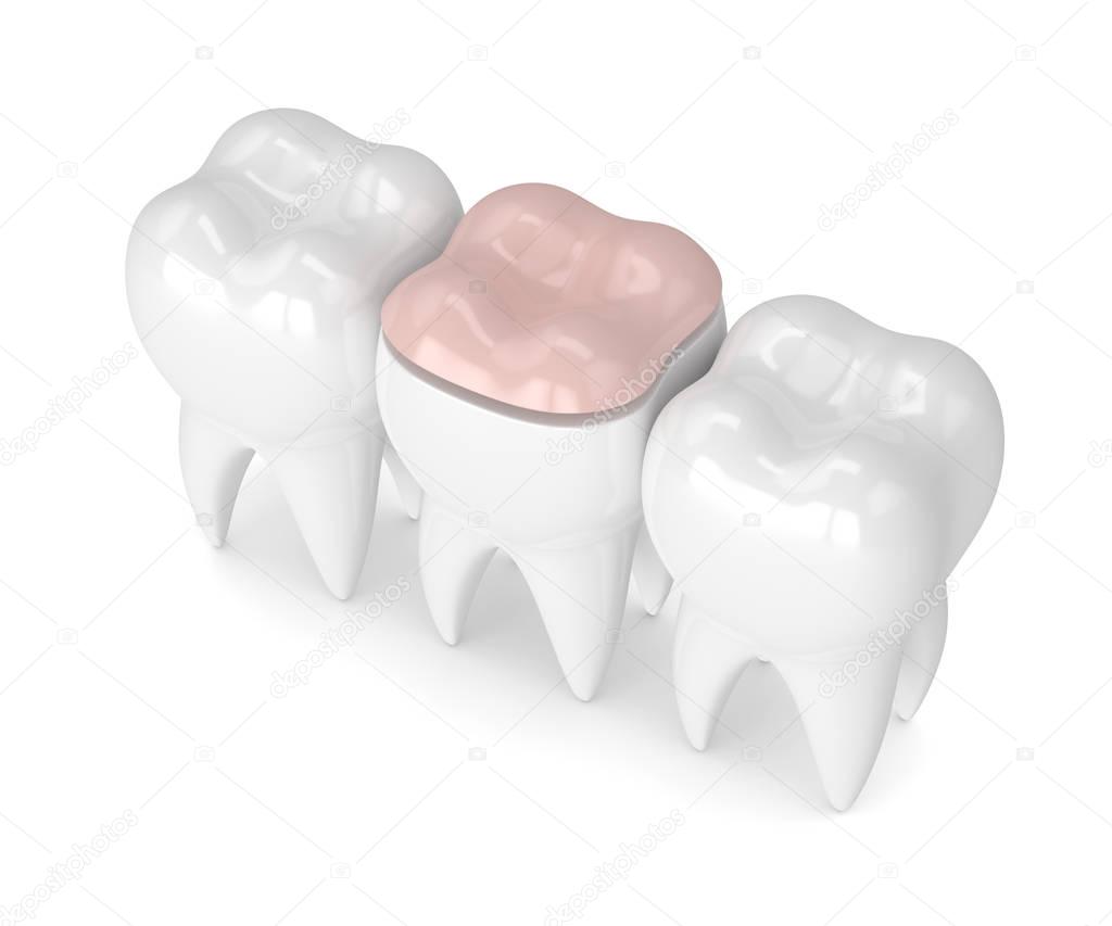 3d render of teeth with dental onlay filling