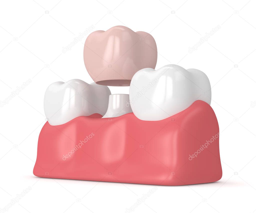 3d render of teeth with dental crown restoration