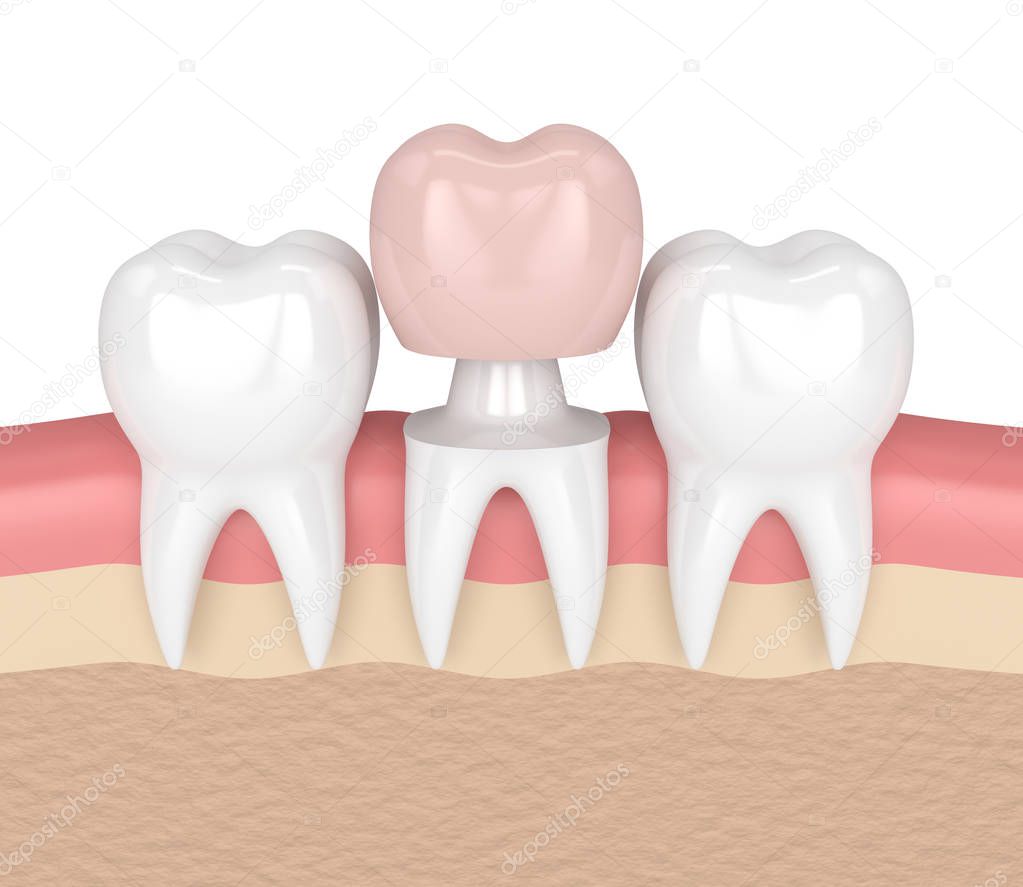 3d render of teeth with dental crown restoration