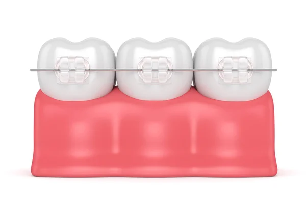 3d renderan gigi dengan kawat gigi yang jelas keramik — Stok Foto