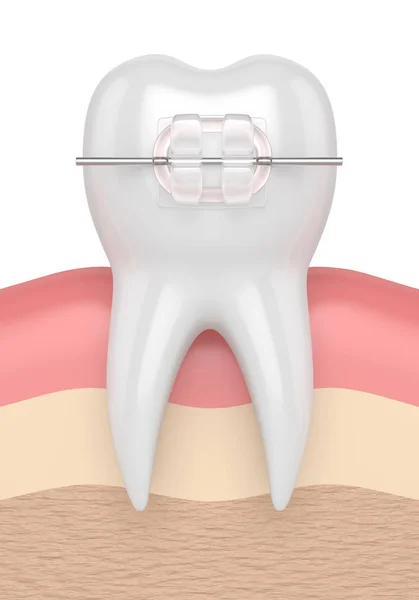 3D renderização de dente com cinta cerâmica clara — Fotografia de Stock