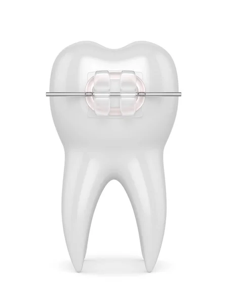 Diş seramik Açık ayraç ile 3D render — Stok fotoğraf