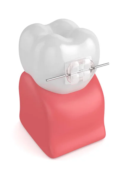 3d renderizado de diente con soporte de cerámica transparente — Foto de Stock