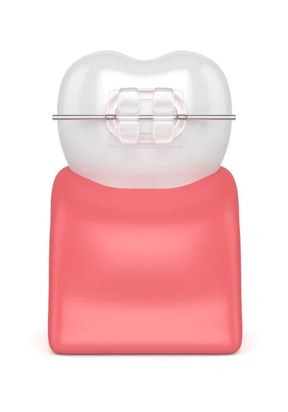 3d renderizado de diente con soporte de cerámica transparente —  Fotos de Stock