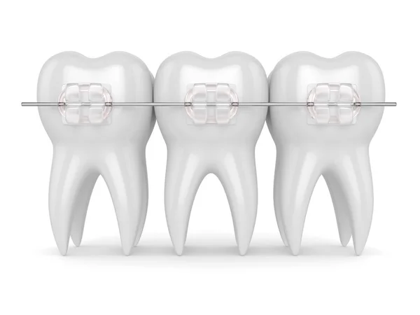 3d render of teeth with ceramic clear braces — Stock Photo, Image