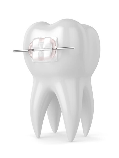3d render of tooth with ceramic clear brace