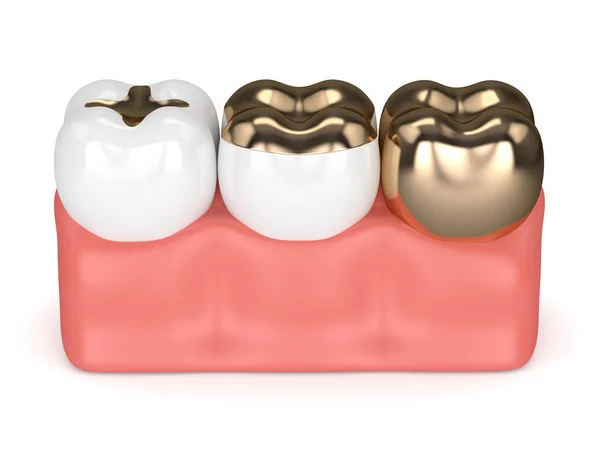 3d render of teeth with different types of dental gold filling — Stock Photo, Image