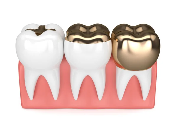 3d render of teeth with different types of dental gold filling — Stock Photo, Image