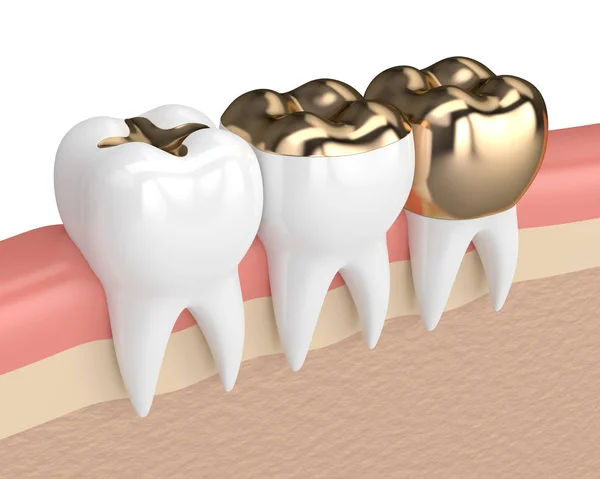3d renderizado de dientes con diferentes tipos de relleno de oro dental — Foto de Stock