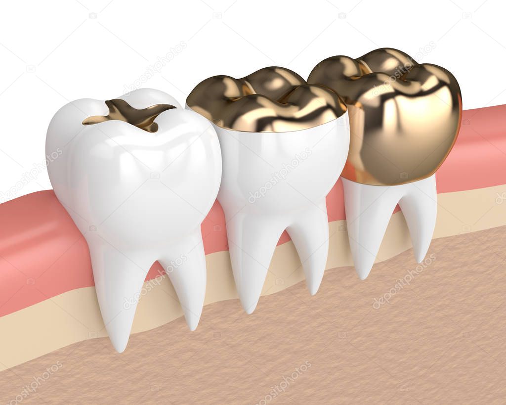 3d render of teeth with different types of dental gold filling