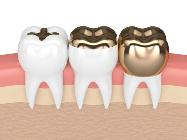 Diş diş altın dolgu farklı tipleri ile 3D render — Stok fotoğraf