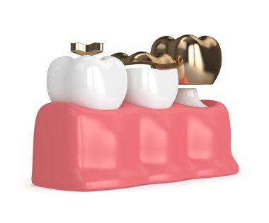 diş diş altın dolgu farklı tipleri ile 3D render