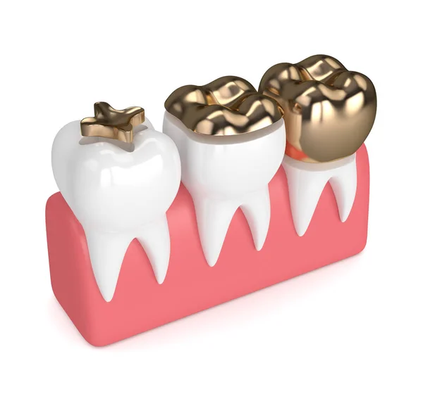 치과 금 작성의 종류와 치아의 3d 렌더링 — 스톡 사진