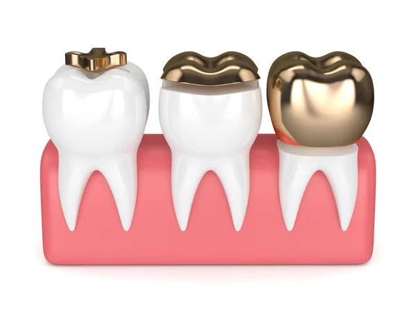 3d render of teeth with different types of dental gold filling — Stock Photo, Image