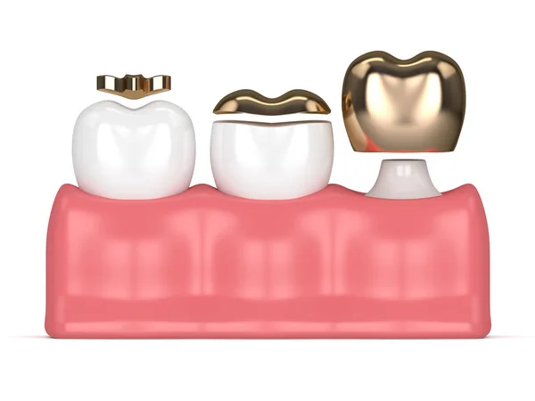 Odwzorowania 3D zębów z różnego rodzaju wypełnień dentystycznych złota — Zdjęcie stockowe