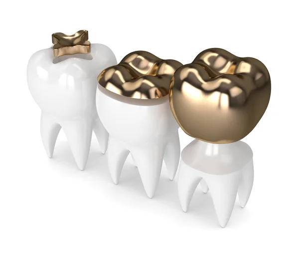 3d render of teeth with different types of dental gold filling — Stock Photo, Image
